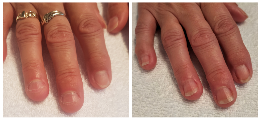 nagelbijten